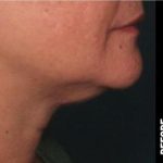 Ultherapy Before & After Patient #1558